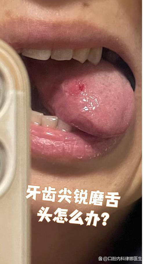 舌根和牙龈被缝一起,舌根和牙龈被缝一起怎么办
